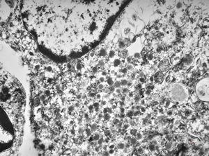 F,68y. | caecum - carcinoid